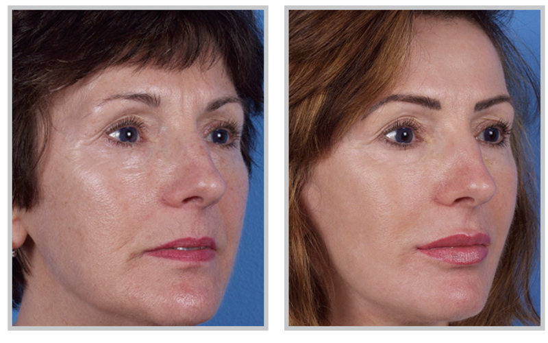 What are the benefits of laser skin resurfacing?